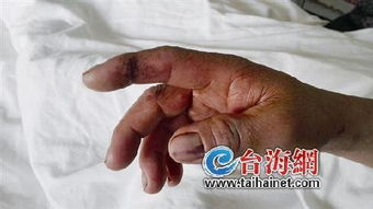 男生因女友咬伤手部疼痛难忍，紧急送医