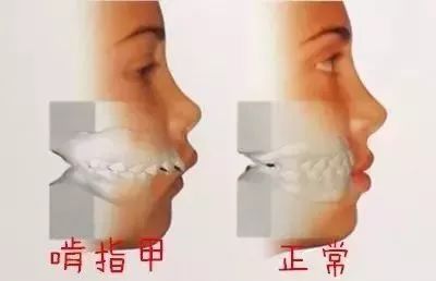 反复啃咬指甲，一种心理障碍的探索