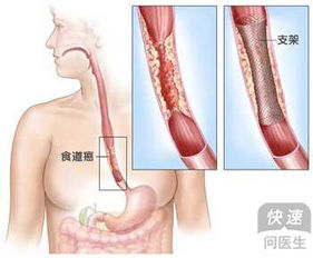 警惕高温食物，长期食用超过65℃食物与食道癌风险