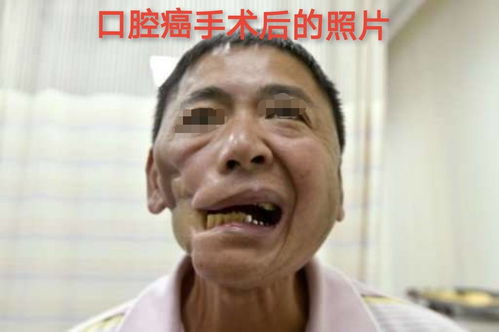 小伙嚼槟榔8年变“大方脸”