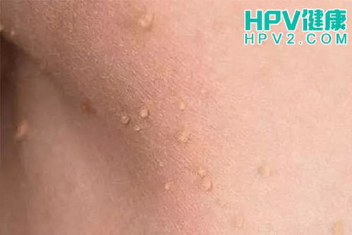  HPV感染，揭秘背后的秘密 hpv是怎么感染上的男性，HPV感染，揭秘男性背后的秘密——HPV感染的感染机制