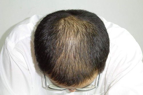 女子因脱发30岁被误认为奶奶